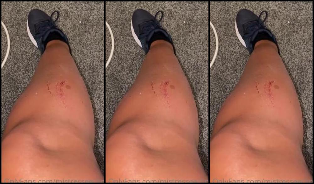 Mistress Eclipse Nicknamed Mistresseeclips Femdom 09 07 2022 Onlyfans Video Wounded By A Wasp Come Lick My Wounds You Dog