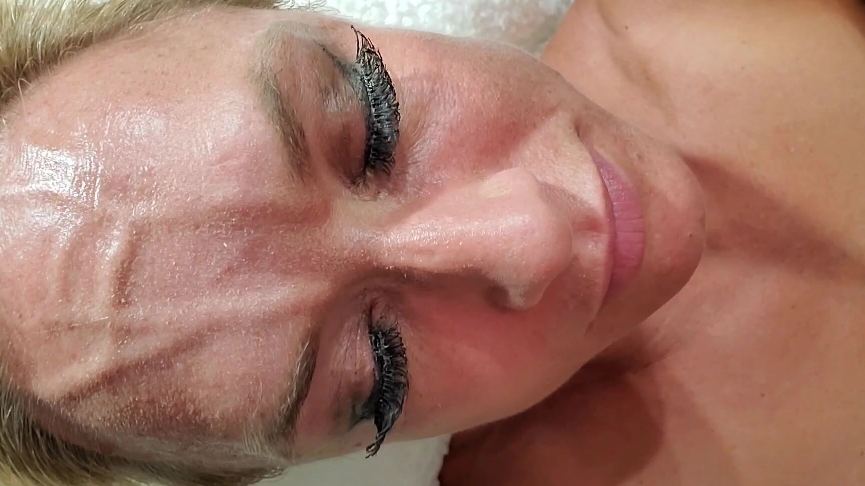 Tqrica Dem Veins Forehead And Neck Veins