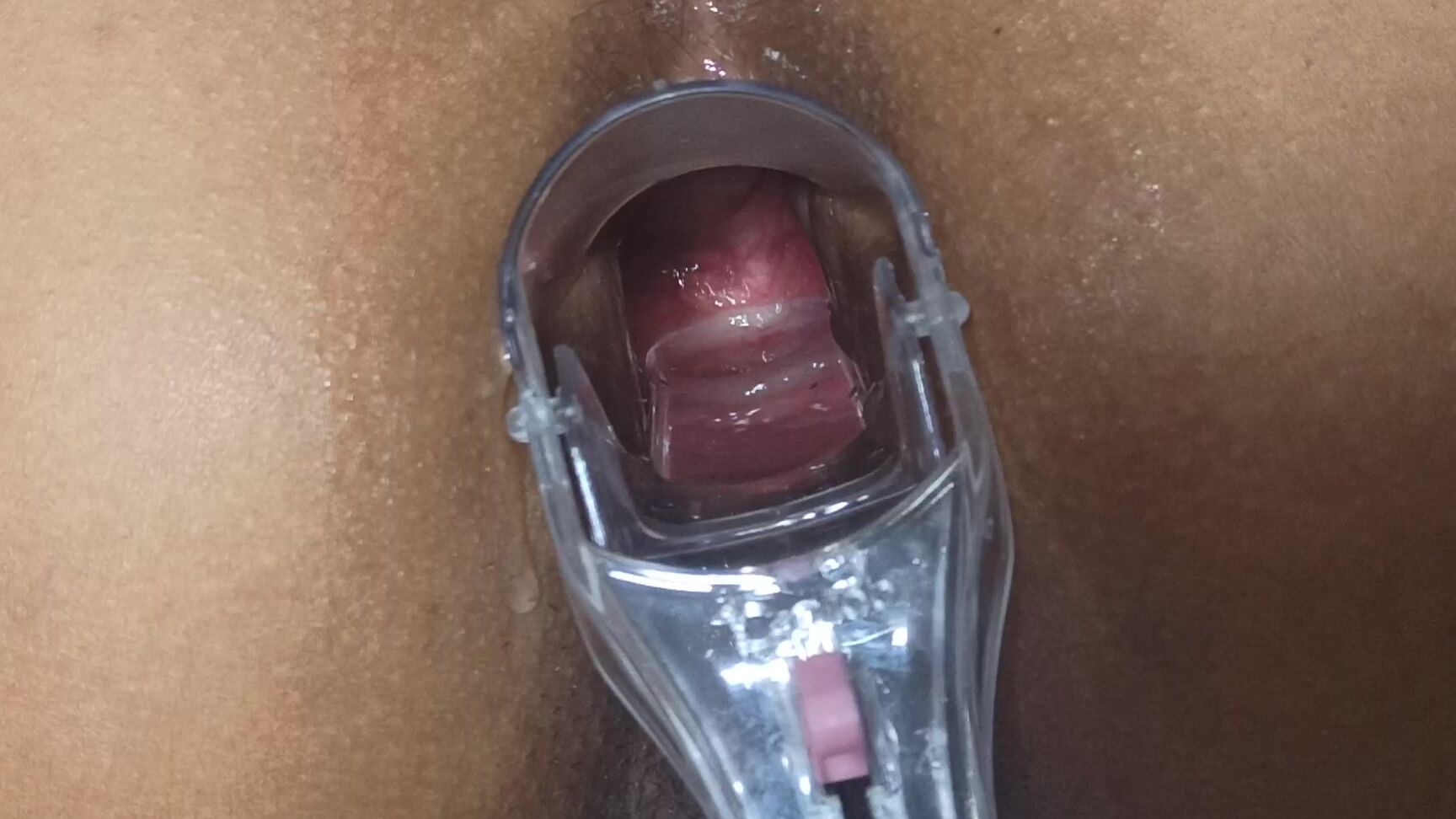 Xamy Speculum In My Anus Part