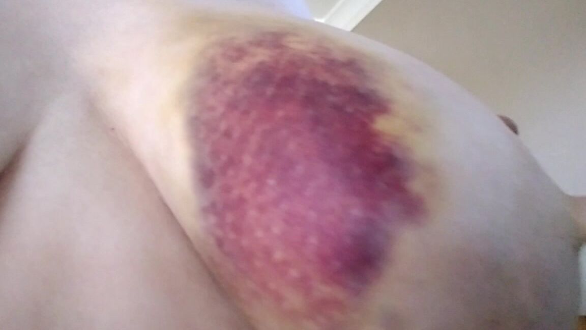 The Elle Hell Car Accident Bruise And Injury Body Tour