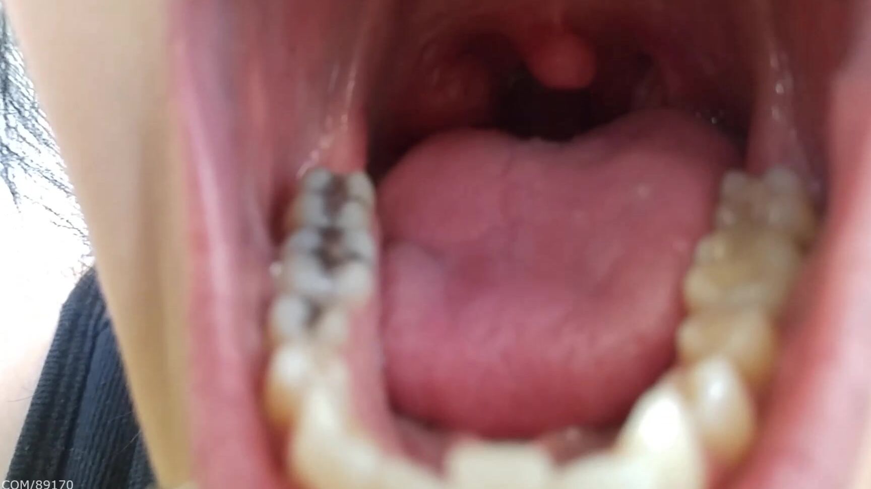 Booty U Teeth Update