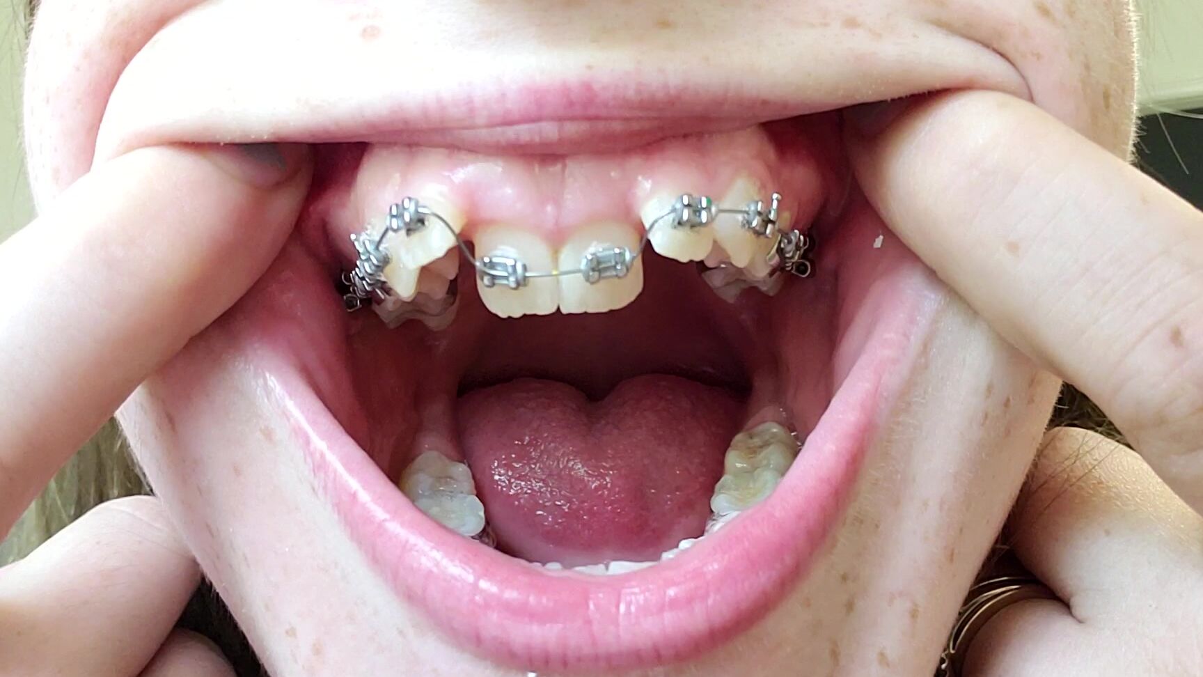 Braces, Mouth Fetish, Spit Fetish, Teeth, Tongue Fetish paige steele mouth spit and braces worship ManyVids