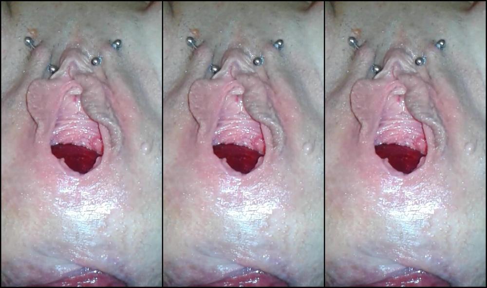 My Anal Prolapse Comes Out With The Apple Look At