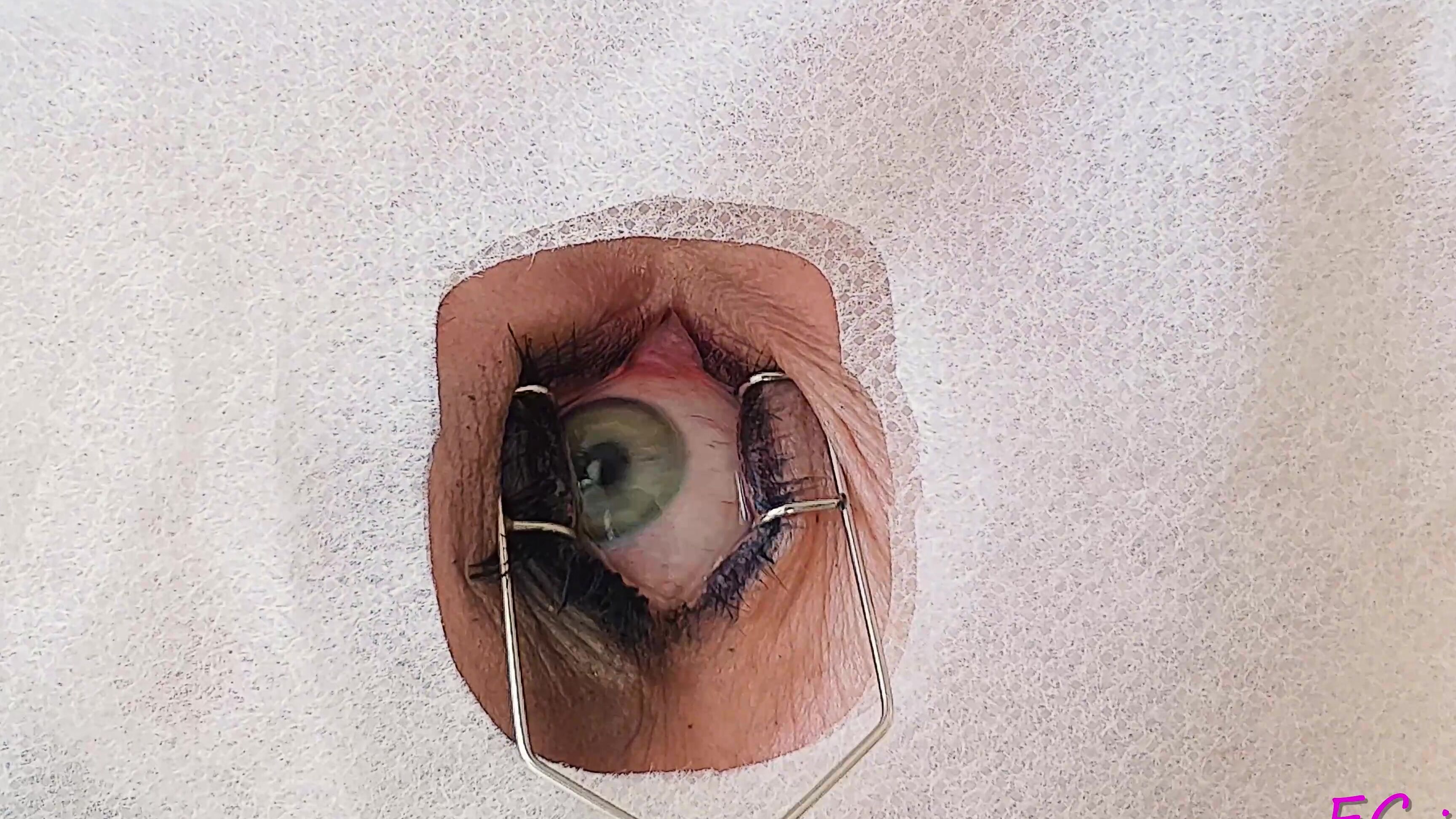 Pinkcandyec Cum Filled Eye With Speculum
